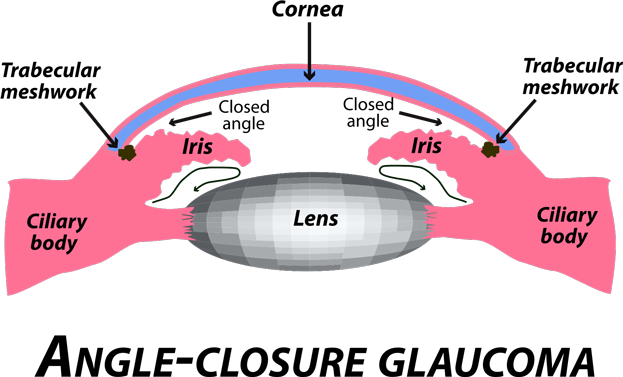 An illustration of angle-closure glaucoma