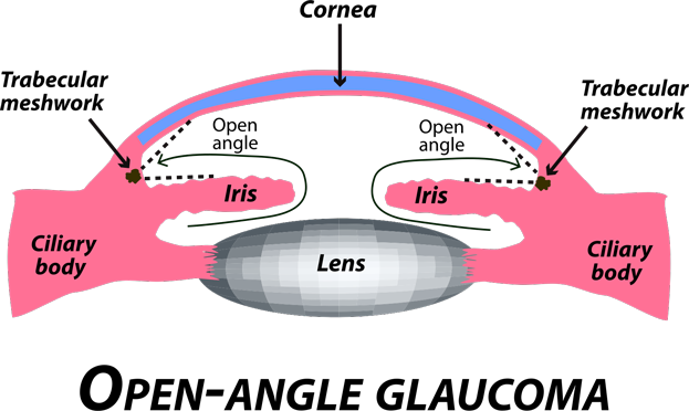 An illustration of open-angle glaucoma