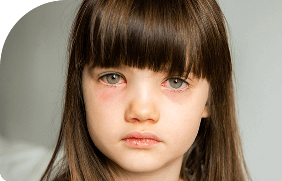 Little girl with pink eye